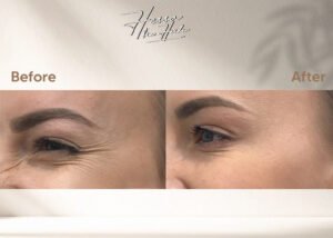 Botox for Crow's Feet