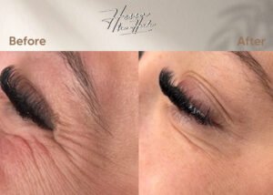 Botox for Crow's Feet