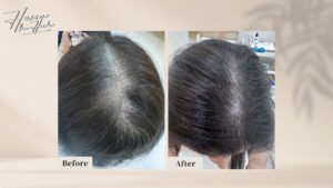 what causes hair loss